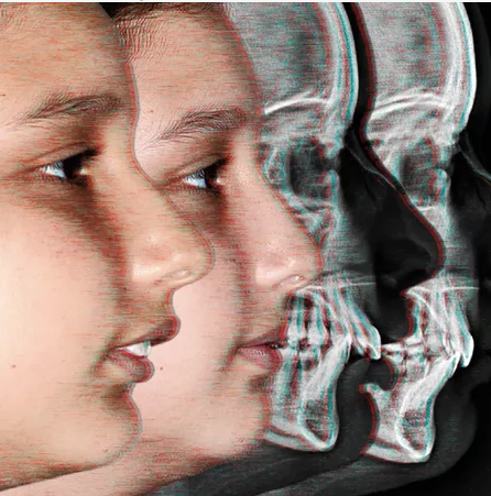 Tratamento híbrido da má oclusão de Classe II esquelética com Ortopedia Funcional e Invisalign em criança com 11 anos de idade